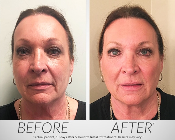 Silhouette Instalift Before and After Naples FL